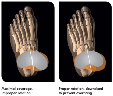 No more compromises on tibial fit & rotation | Conformis