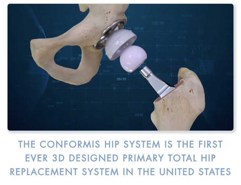 Conformis Announces the first 3D Total Hip Replacement Surgeries