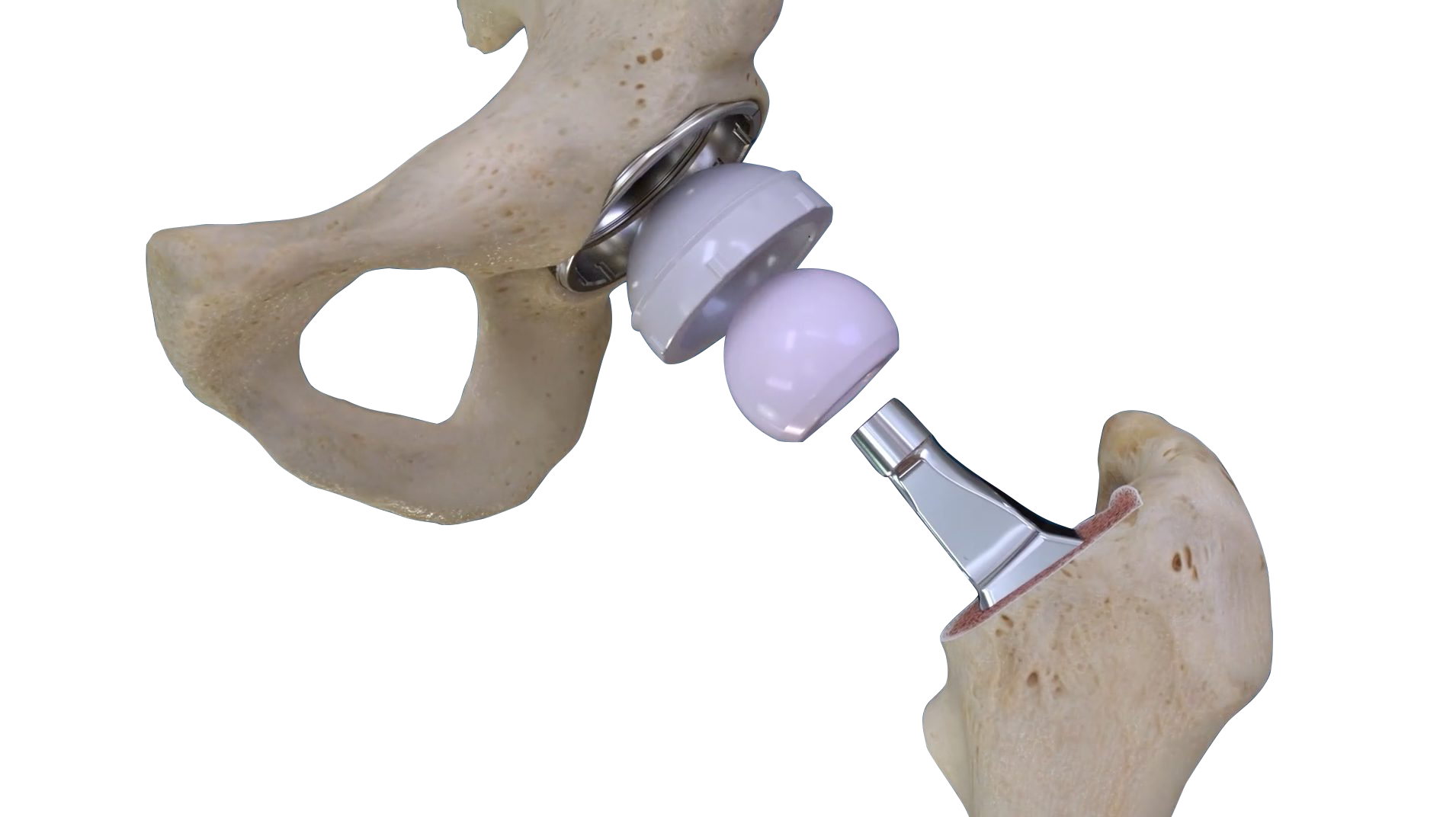 The 3D designed Conformis Hip System Announced at the 2019 AAOS