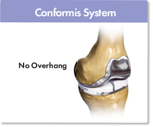 Fully-personalized knee replacement with no overhang