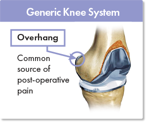 Generic knee replacement with overhang