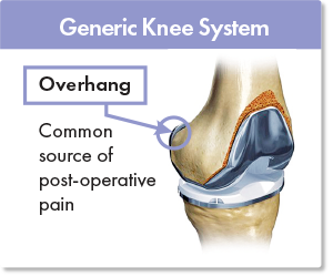 Generic knee replacement with overhang