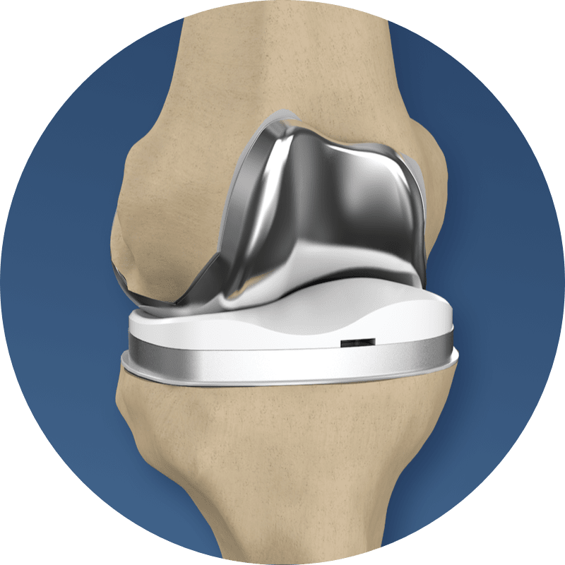 Conformis Implant for Knee Replacement